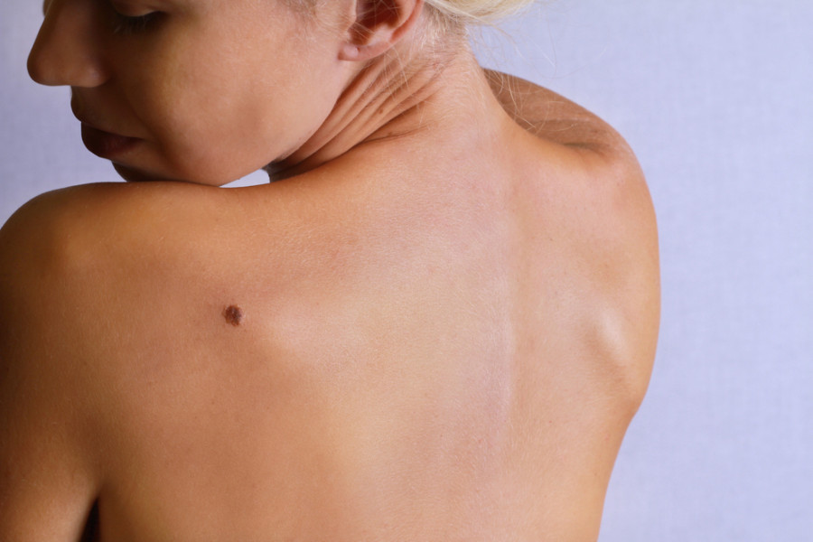 Da li treba preventivno uklanjati mladeže? Dermatolog otkriva pet znakova koji mogu da ukazuju na rak kože