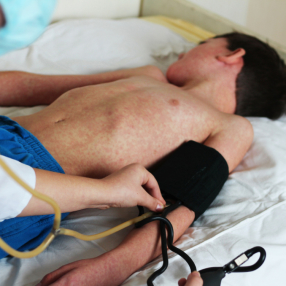 Dvoje umrlo, puno zaraženih, a lekari tvrde – epidemija opada