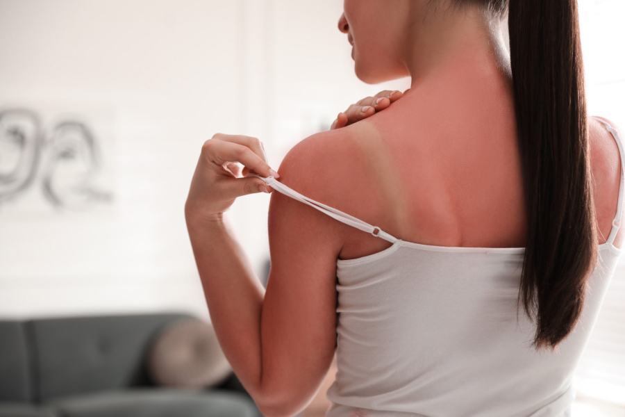 Dermatolozi upozoravaju da je trovanje suncem moguće, ovo je prvi simptom