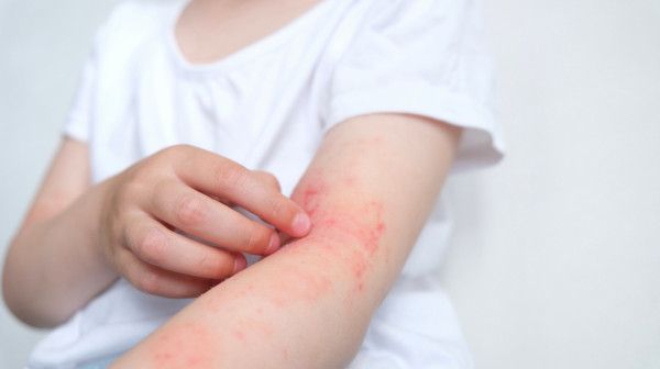 Potresna ispovest žene alergične na sunce: "Mislila sam da je moj život gotov"