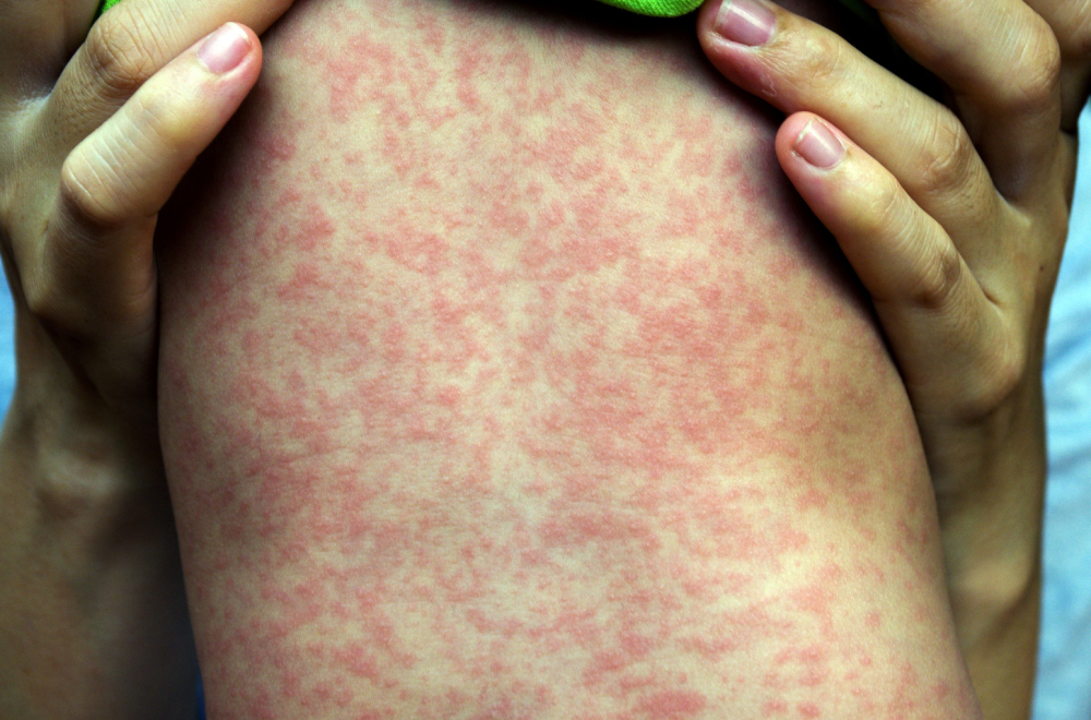 Epidemija malih boginja u ovom gradu: Više od 60 dece zaraženo, u riziku 160.000 FOTO
