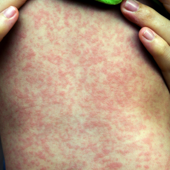Epidemija malih boginja u ovom gradu: Više od 60 dece zaraženo, u riziku 160.000 FOTO