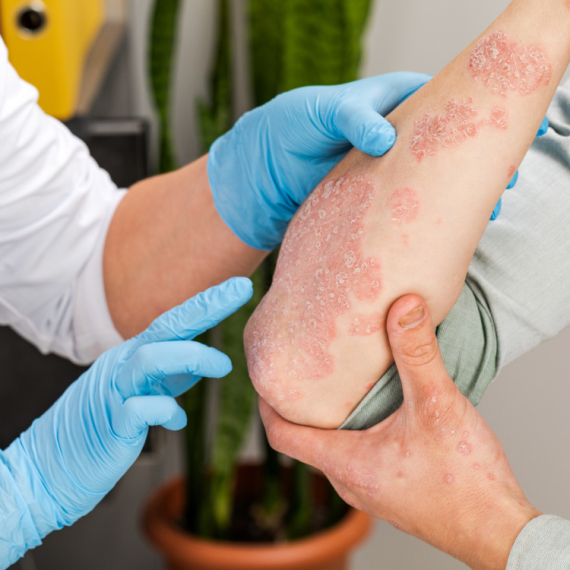 Zajedno protiv psorijaze: Edukacija i podrška na Svetski dan borbe