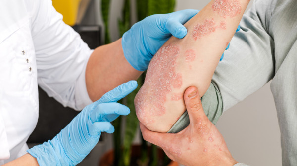 Sunce i muke s psorijazom: Spas u biološkoj terapiji