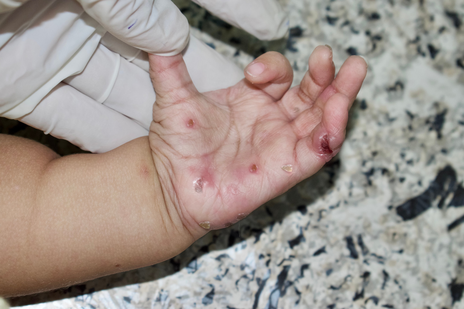 Šta da radite ako posumnjate na infekciju: Kako da prepoznate šugu i kako se bolest prenosi?