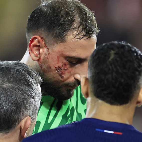 Uznemirujuće slike – Donarumi unakaženo lice FOTO/VIDEO