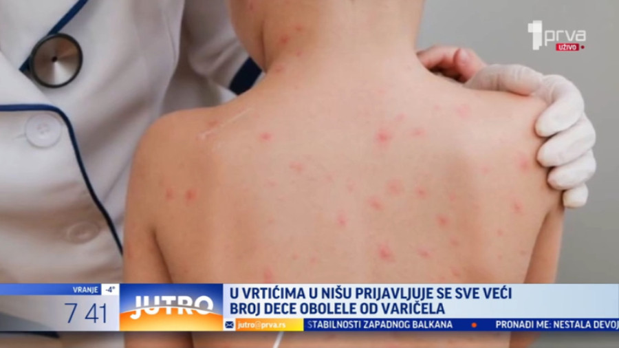 Ovo je jedna od najčešćih bolesti koja se lako prenosi i širi u kolektivima