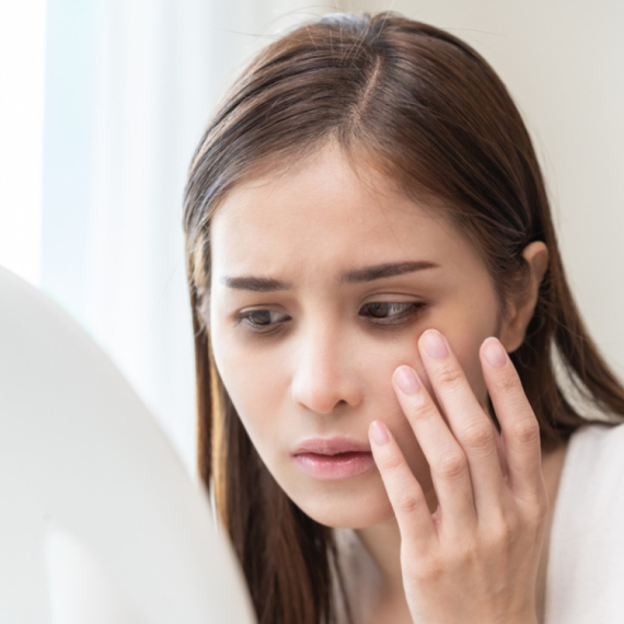 Imate tamne krugove ispod očiju? Možda vam nedostaje ovaj vitamin