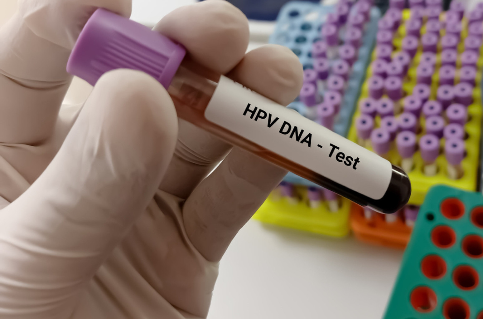 Tеstirаnjе istоvrеmеnоm primеnоm HPV i PАP tеstа u Bеоgrаdu dо 11. јulа