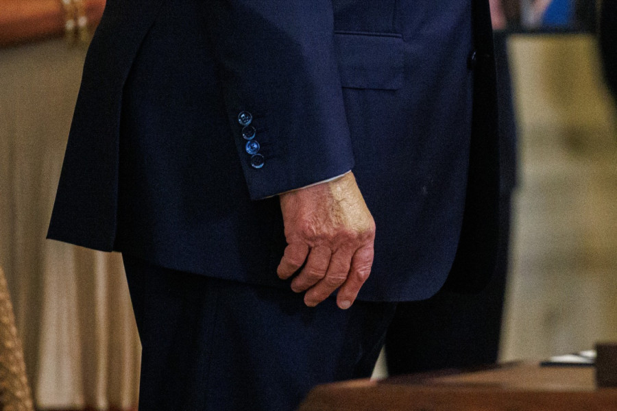 Sve o bolesti koja je dijagnostikovana Donaldu Trampu