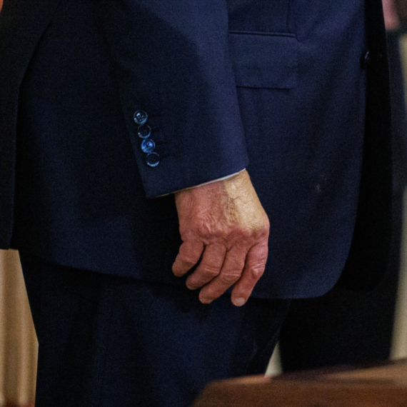 Donald Tramp krije bolest? Pokušao je da sakrije šminkom, ali... FOTO