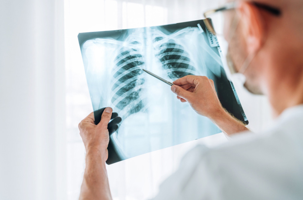 U Srbiji 410 slučajeva tuberkuloze: Deca sve ređe obolevaju, muškarci i stariji najviše pogođeni