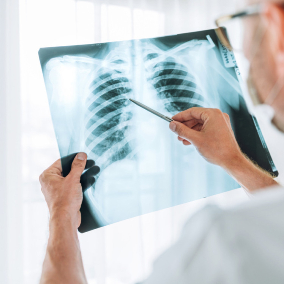U Srbiji 410 slučajeva tuberkuloze: Deca sve ređe obolevaju, muškarci i stariji najviše pogođeni