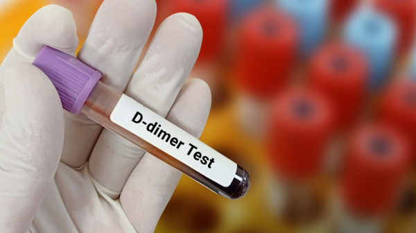 D-dimer test: Šta znači povišen nalaz i kada je vreme za brigu?