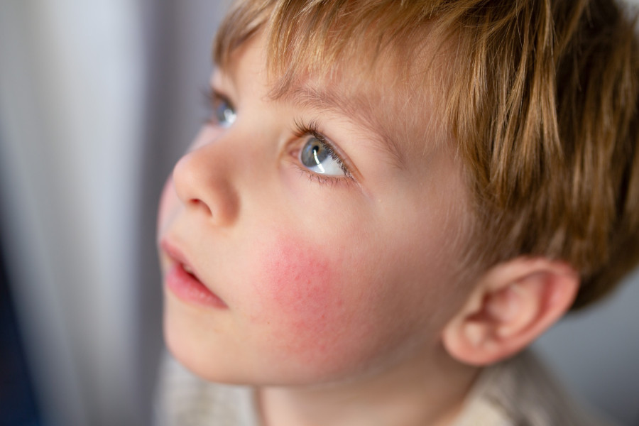Kad svaki dodir peče: Dermatolog savetuje kako se boriti sa atopijskim dermatitisom VIDEO