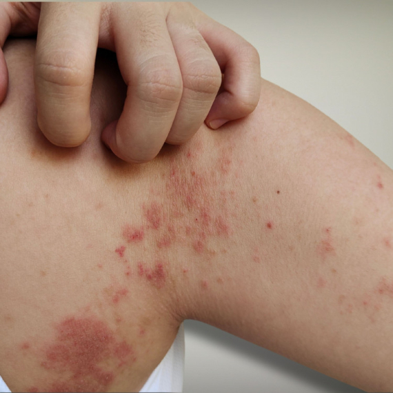 Impetigo se širi po Jadranu; Lekari upozoravaju: "Pridržavajte se ovih pravila"
