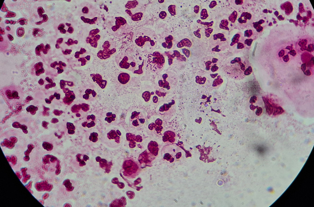 Opasna infekcija širi se Evropom: Polna bolest sve otpornija na antibiotike