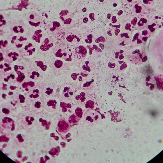 Opasna infekcija širi se Evropom: Polna bolest sve otpornija na antibiotike