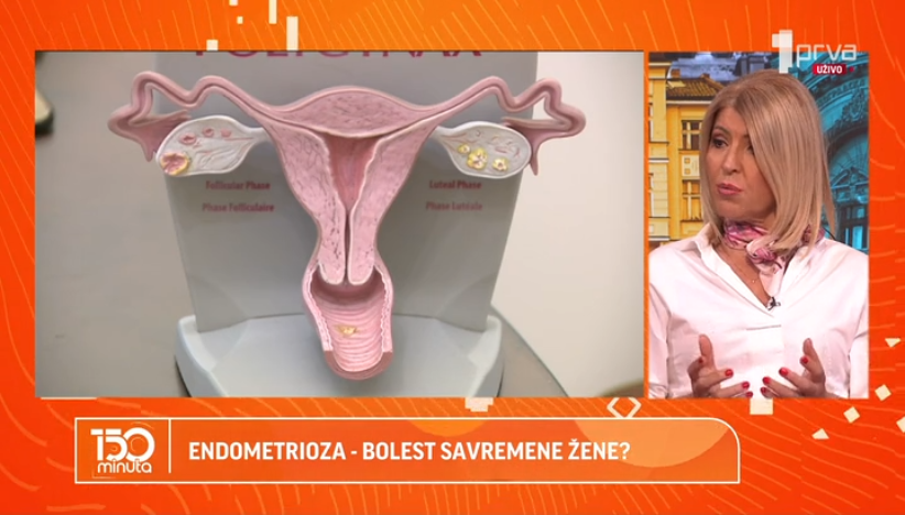 Endometrioza, bolest savremene žene