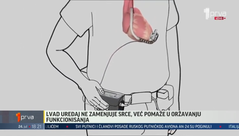 Operacija srca